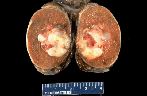 tumore del testicolo