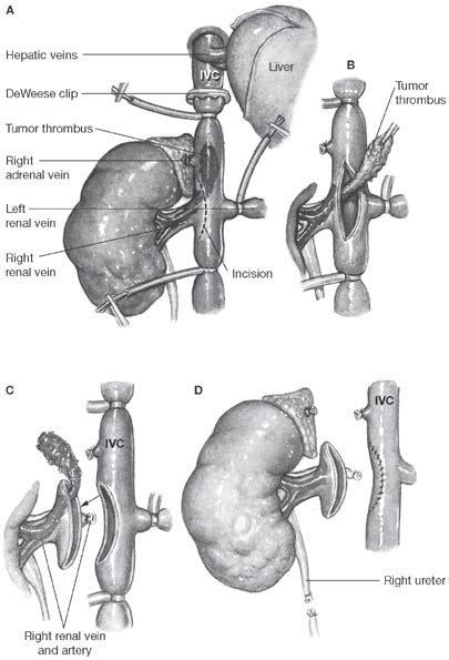 tumore renale